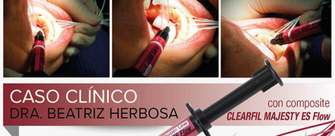 composite Clearfil Majesty Flow