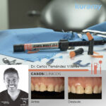 ¿Por qué le gustan los composites dentales Univers...