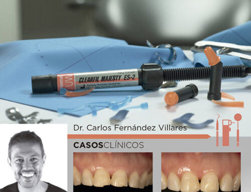 ¿Por qué le gustan los composites dentales Universales a Carlos Fernández Villares?